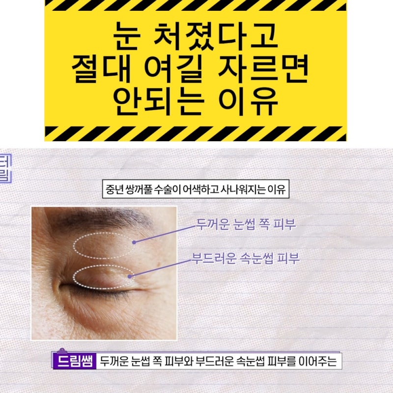 윗집 아줌마 쌍꺼풀 망했다며? 중년쌍꺼풀은 따로 있는데 아가씨들 하는걸 했대..