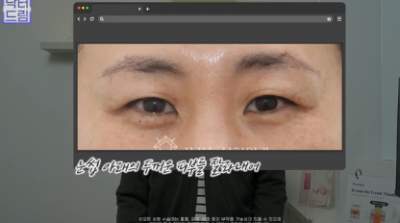 윗집 아줌마 쌍꺼풀 망했다며? 중년쌍꺼풀은 따로 있는데 아가씨들 하는걸 했대.. 사진 8