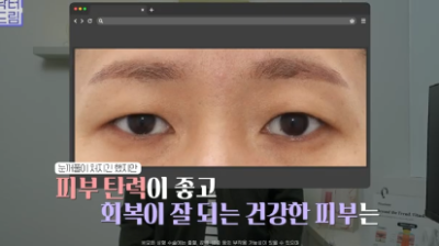 윗집 아줌마 쌍꺼풀 망했다며? 중년쌍꺼풀은 따로 있는데 아가씨들 하는걸 했대.. 사진 28