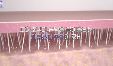 3대 피부레이저 루머, 오늘 진실을 밝힙니다 사진 5