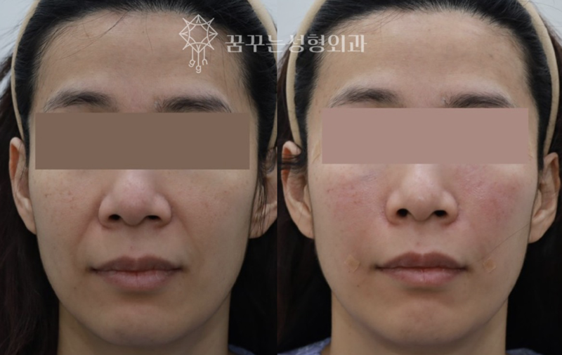 팔자주름 리프팅 비교 – 민트실 vs 필러 vs 리프팅 레이저강남역 안티에이징 전문 성형외과, 꿈꾸는 성형외과의 맞춤 해법 사진 11