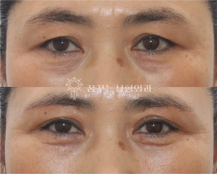 중년 눈처짐, 상안검 수술만이 답일까요? 자연스럽게 눈뜨임 개선하기 강남역 꿈꾸는성형외과 사진 5