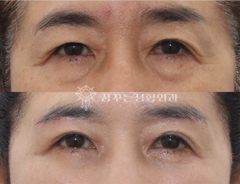 중년 눈처짐, 상안검 수술만이 답일까요? 자연스럽게 눈뜨임 개선하기 강남역 꿈꾸는성형외과