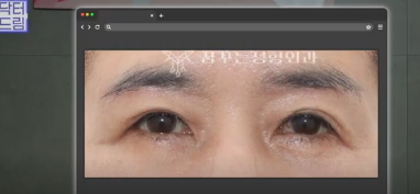 중년성형 필독! 망하는 병원 고르는 치명적 실수 3가지 사진 18
