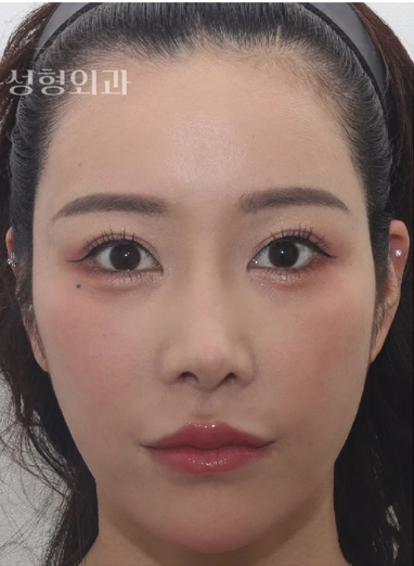 눈꺼풀 처짐, 쌍수 재수술보다 이마거상이 맞을 때강남역 이마거상 전문｜꿈꾸는 성형외과 사진 7