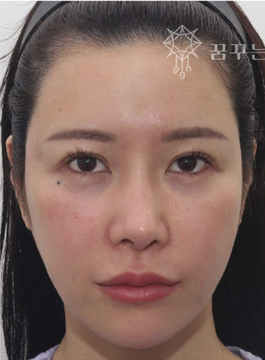 눈꺼풀 처짐, 쌍수 재수술보다 이마거상이 맞을 때강남역 이마거상 전문｜꿈꾸는 성형외과 사진 6