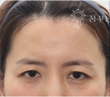 눈꺼풀 처짐, 쌍수 재수술보다 이마거상이 맞을 때강남역 이마거상 전문｜꿈꾸는 성형외과 사진 3