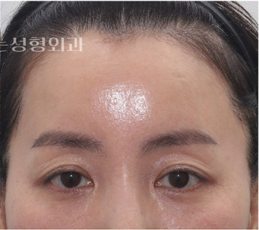 눈꺼풀 처짐, 쌍수 재수술보다 이마거상이 맞을 때강남역 이마거상 전문｜꿈꾸는 성형외과 사진 4