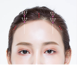 눈꺼풀 처짐, 쌍수 재수술보다 이마거상이 맞을 때강남역 이마거상 전문｜꿈꾸는 성형외과 사진 5
