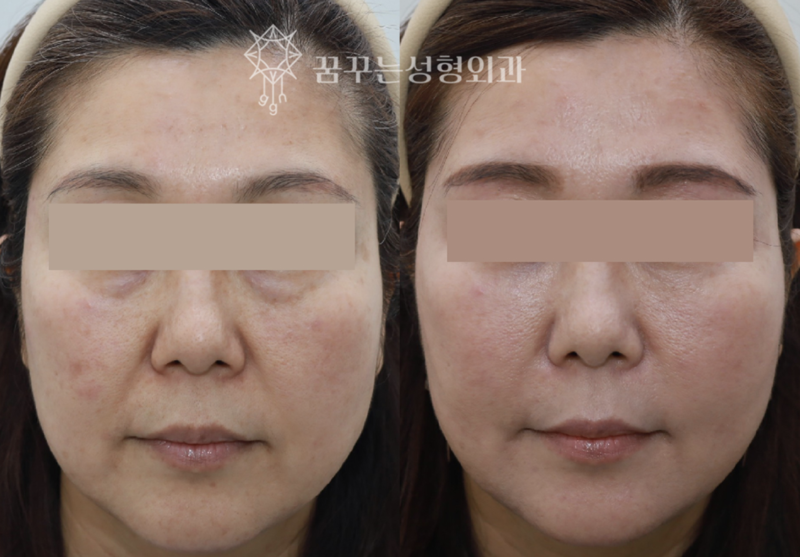 중안면 리프팅으로 동안 얼굴 만들기팔자주름·실리프팅으로 어려 보이는 인상 강남역 꿈꾸는 성형외과 사진 8