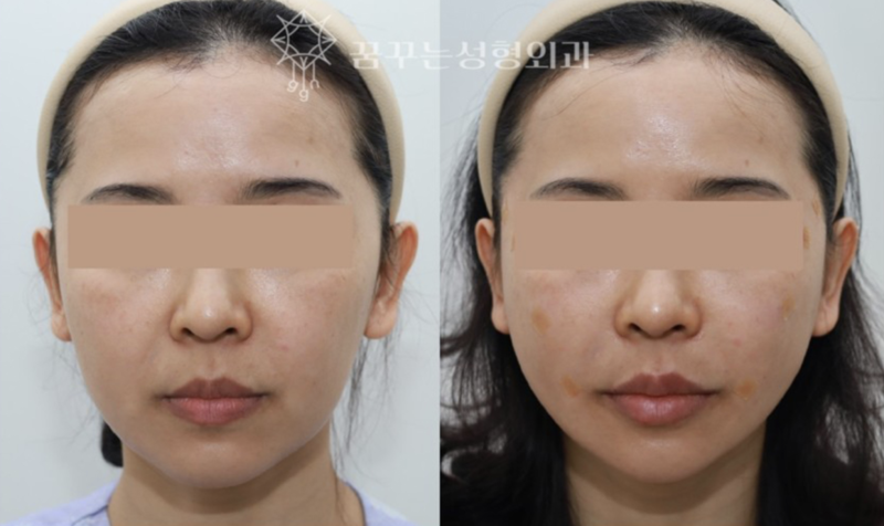 중안면 리프팅으로 동안 얼굴 만들기팔자주름·실리프팅으로 어려 보이는 인상 강남역 꿈꾸는 성형외과