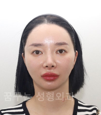 중안면 리프팅으로 동안 얼굴 만들기팔자주름·실리프팅으로 어려 보이는 인상 강남역 꿈꾸는 성형외과 사진 12