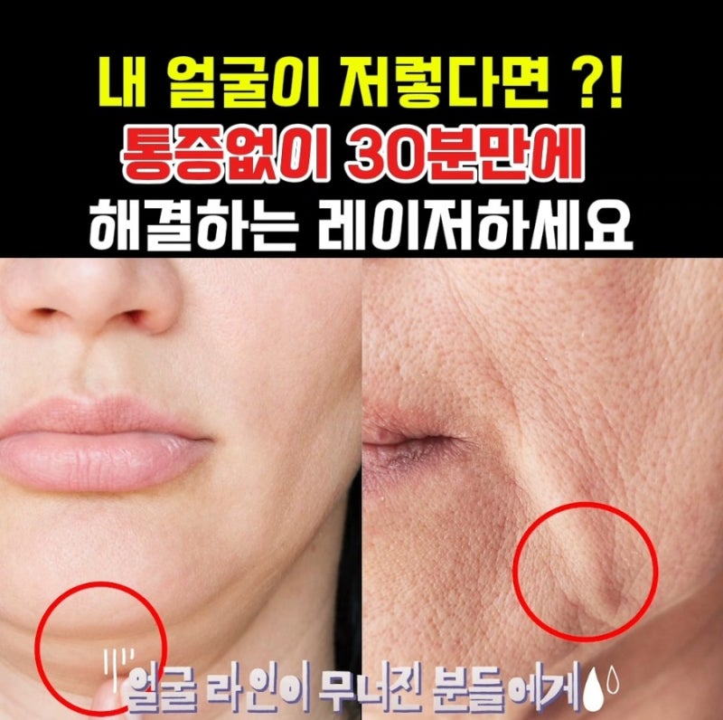 도곡동 최애레이저, 온다vs티타늄 상세분석