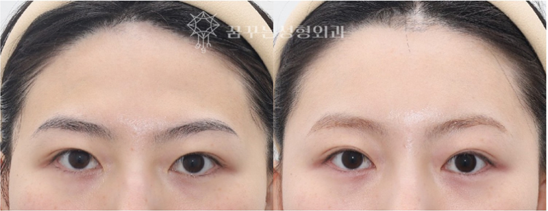 쌍꺼풀 재수술 전에 꼭 확인하세요｜강남역 성형외과 눈 수술 선택 가이드, 내시경 이마거상이 먼저 필요한 이유 사진 9