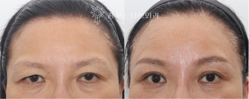 쌍꺼풀 재수술 전에 꼭 확인하세요｜강남역 성형외과 눈 수술 선택 가이드, 내시경 이마거상이 먼저 필요한 이유 사진 12