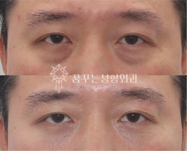 다크서클의 진짜 원인, 색소가 아니라 ‘구조’입니다. 눈밑지방재배치가 필요한 이유｜강남역 성형외과 눈밑 성형 가이드 사진 7