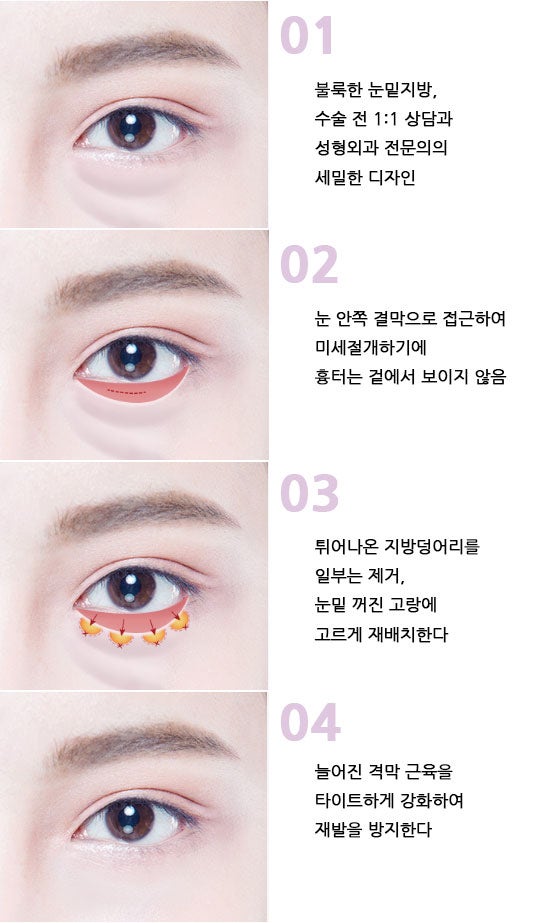 다크서클의 진짜 원인, 색소가 아니라 ‘구조’입니다. 눈밑지방재배치가 필요한 이유｜강남역 성형외과 눈밑 성형 가이드 사진 3