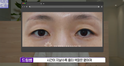 미인대회 출신 사부인 가볍게 밟아버린 중년동안수술 사진 31