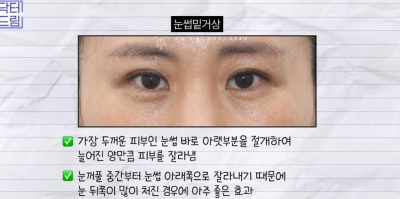 미인대회 출신 사부인 가볍게 밟아버린 중년동안수술 사진 30