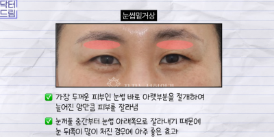미인대회 출신 사부인 가볍게 밟아버린 중년동안수술 사진 29