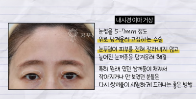 미인대회 출신 사부인 가볍게 밟아버린 중년동안수술 사진 15