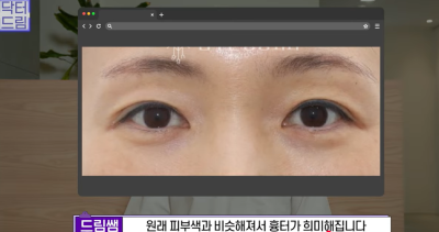 미인대회 출신 사부인 가볍게 밟아버린 중년동안수술 사진 32