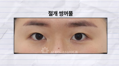 미인대회 출신 사부인 가볍게 밟아버린 중년동안수술 사진 3