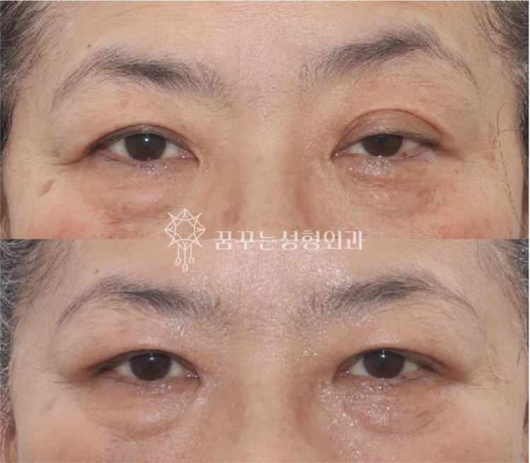 우리 부모님 인상이 달라졌어요｜요즘 효도 선물로 선택되는 상안검·하안검 수술 사진 6