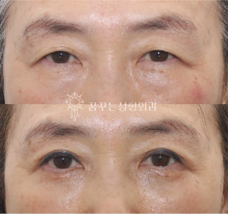 우리 부모님 인상이 달라졌어요｜요즘 효도 선물로 선택되는 상안검·하안검 수술 사진 5