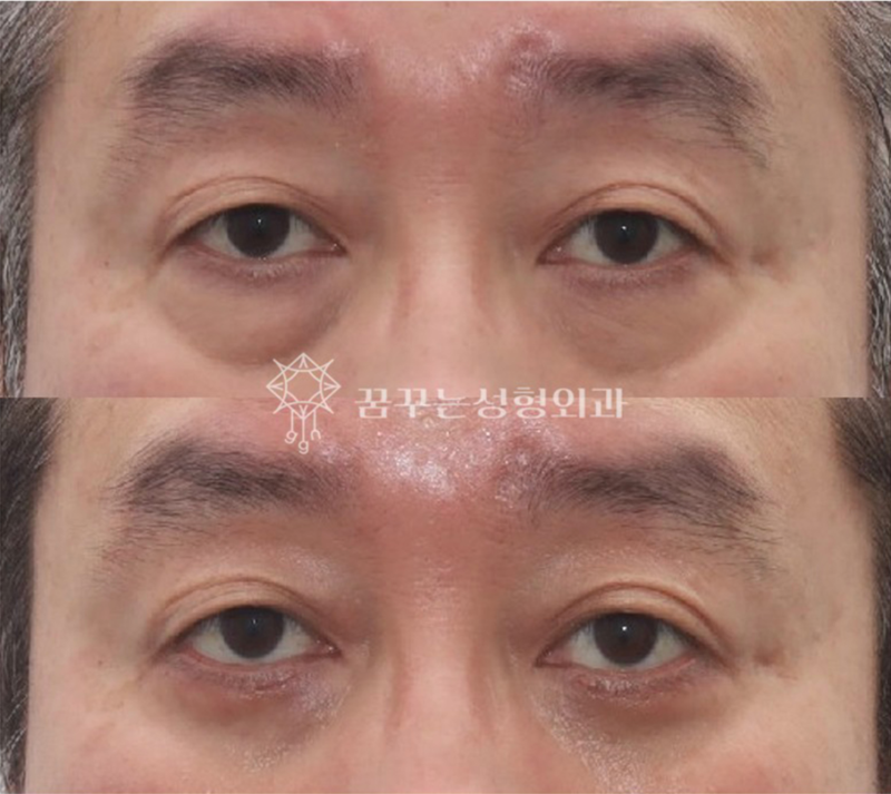 우리 부모님 인상이 달라졌어요｜요즘 효도 선물로 선택되는 상안검·하안검 수술 사진 7