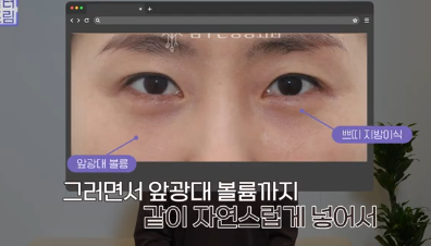 더 새로워지고 더 강력해진, 꼭 알아야하는 2026 중년성형트렌드 사진 6