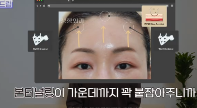 더 새로워지고 더 강력해진, 꼭 알아야하는 2026 중년성형트렌드 사진 21