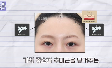 더 새로워지고 더 강력해진, 꼭 알아야하는 2026 중년성형트렌드 사진 16
