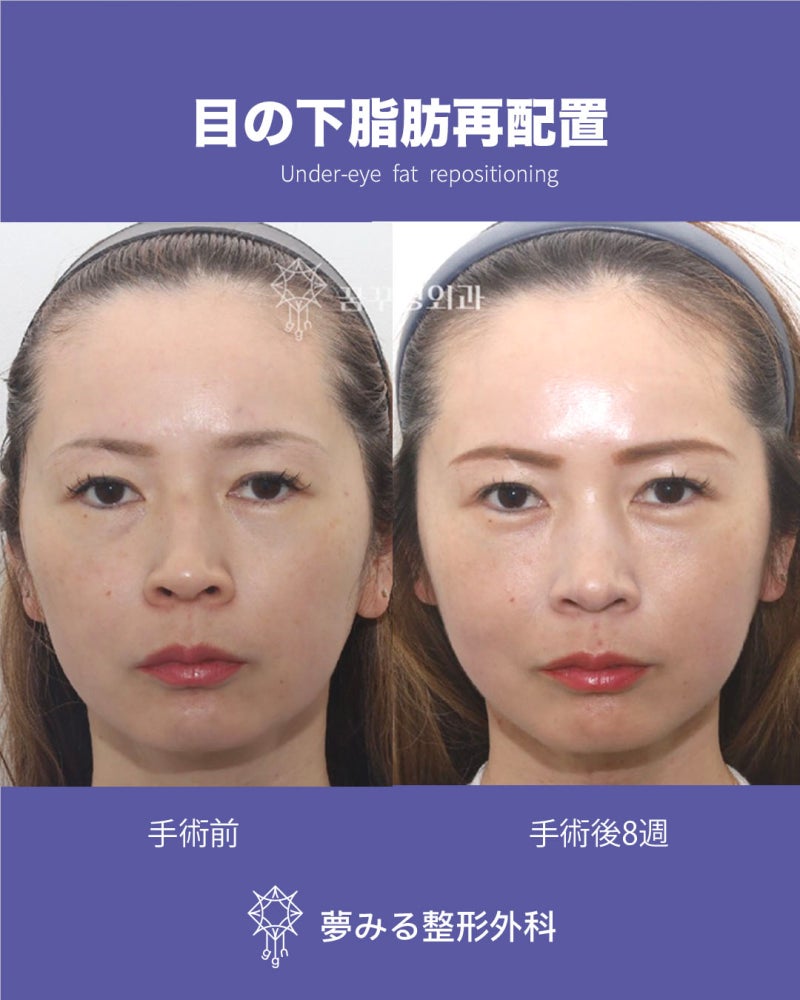 강남 상안검 잘하는 곳?하안검·눈성형 추천 성형외과를 챗지피티에게 물어봤다 사진 8