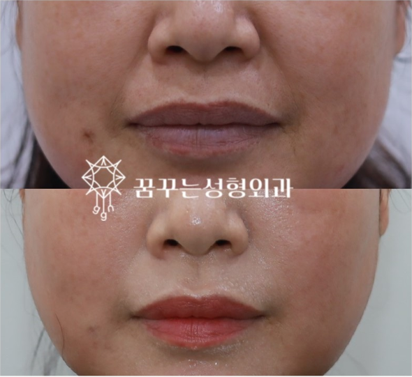 팔자주름 실리프팅 효과 있을까? 꿈꾸는 성형외과 ‘꿈프팅’으로 달라지는 이유 사진 4