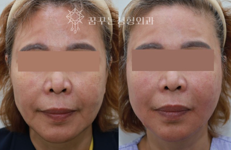 팔자주름 실리프팅 효과 있을까? 꿈꾸는 성형외과 ‘꿈프팅’으로 달라지는 이유 사진 5