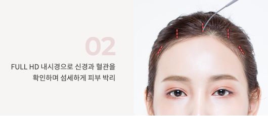강남 내시경 이마거상 잘하는 곳 찾는다면? 자연스러운 눈매 개선, 꿈꾸는 성형외과 사진 4