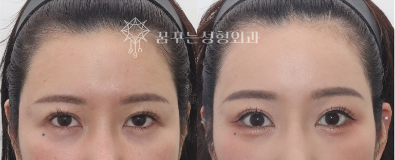 강남 내시경 이마거상 잘하는 곳 찾는다면? 자연스러운 눈매 개선, 꿈꾸는 성형외과 사진 10