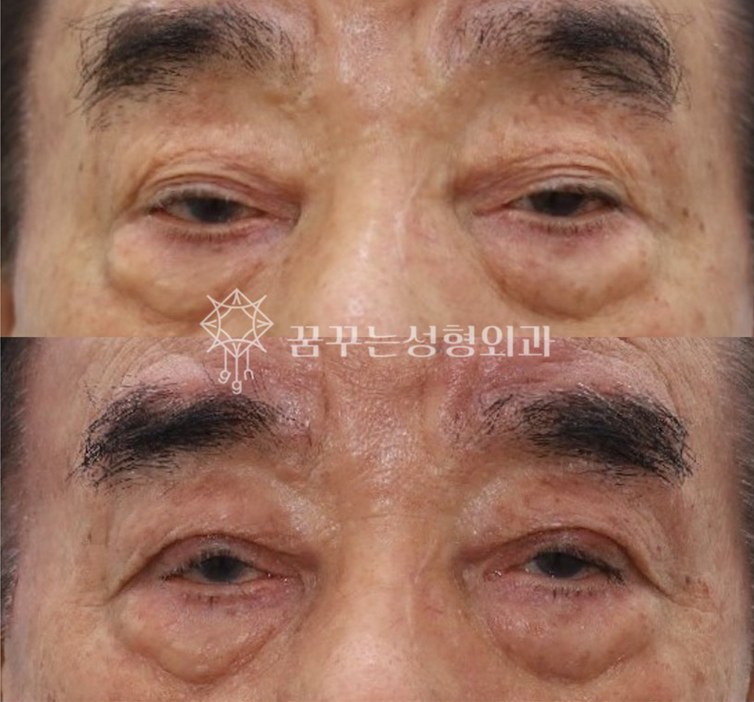 중년 남성 안티에이징 필수 수술눈밑지방재배치, 상안검, 하안검 차이와 효과 사진 8