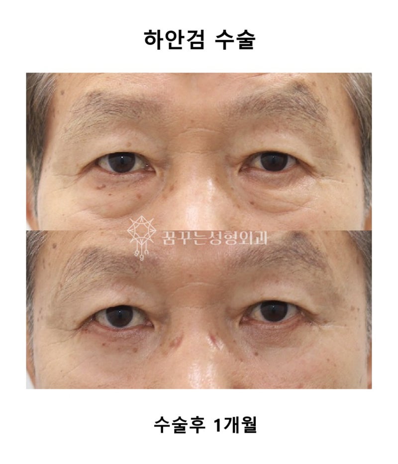 중년 남성 안티에이징 필수 수술눈밑지방재배치, 상안검, 하안검 차이와 효과 사진 9