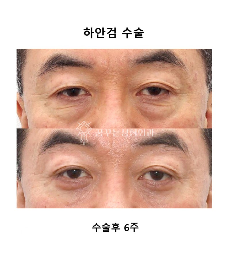 중년 남성 안티에이징 필수 수술눈밑지방재배치, 상안검, 하안검 차이와 효과 사진 10