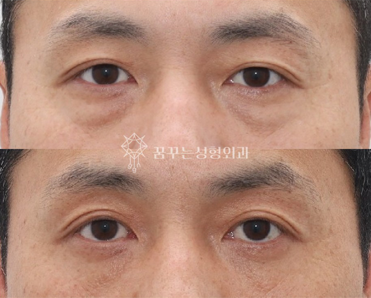 중년 남성 안티에이징 필수 수술눈밑지방재배치, 상안검, 하안검 차이와 효과 사진 6