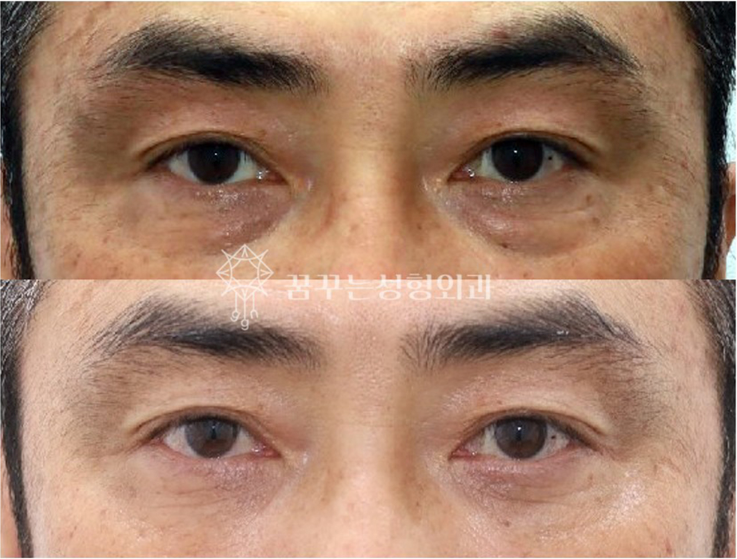 중년 남성 안티에이징 필수 수술눈밑지방재배치, 상안검, 하안검 차이와 효과