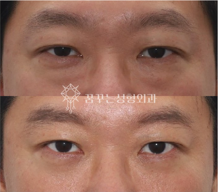 중년 남성 안티에이징 필수 수술눈밑지방재배치, 상안검, 하안검 차이와 효과 사진 4