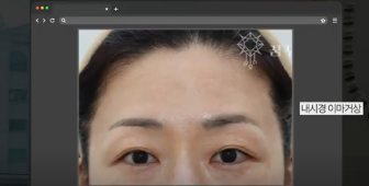 이번 연휴, 남들 쉴 때 예뻐질 결심! 기간별 성형족보총정리(feat.어버이날 선물) 사진 23