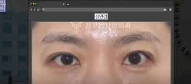 이번 연휴, 남들 쉴 때 예뻐질 결심! 기간별 성형족보총정리(feat.어버이날 선물) 사진 20