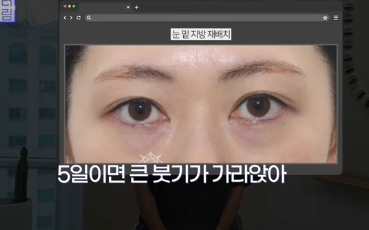 이번 연휴, 남들 쉴 때 예뻐질 결심! 기간별 성형족보총정리(feat.어버이날 선물) 사진 14