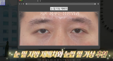 이번 연휴, 남들 쉴 때 예뻐질 결심! 기간별 성형족보총정리(feat.어버이날 선물) 사진 9