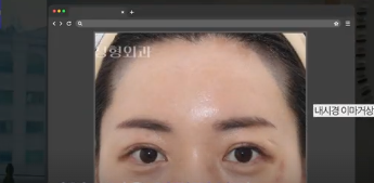 이번 연휴, 남들 쉴 때 예뻐질 결심! 기간별 성형족보총정리(feat.어버이날 선물) 사진 18
