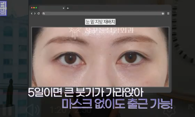 이번 연휴, 남들 쉴 때 예뻐질 결심! 기간별 성형족보총정리(feat.어버이날 선물) 사진 15